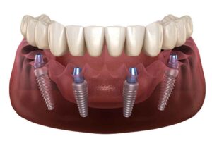 Why Dental Implants Are Changing the Way Dentists Talk About Long-Term Oral Health