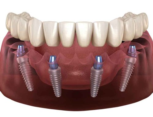 Why Dental Implants Are Changing the Way Dentists Talk About Long-Term Oral Health