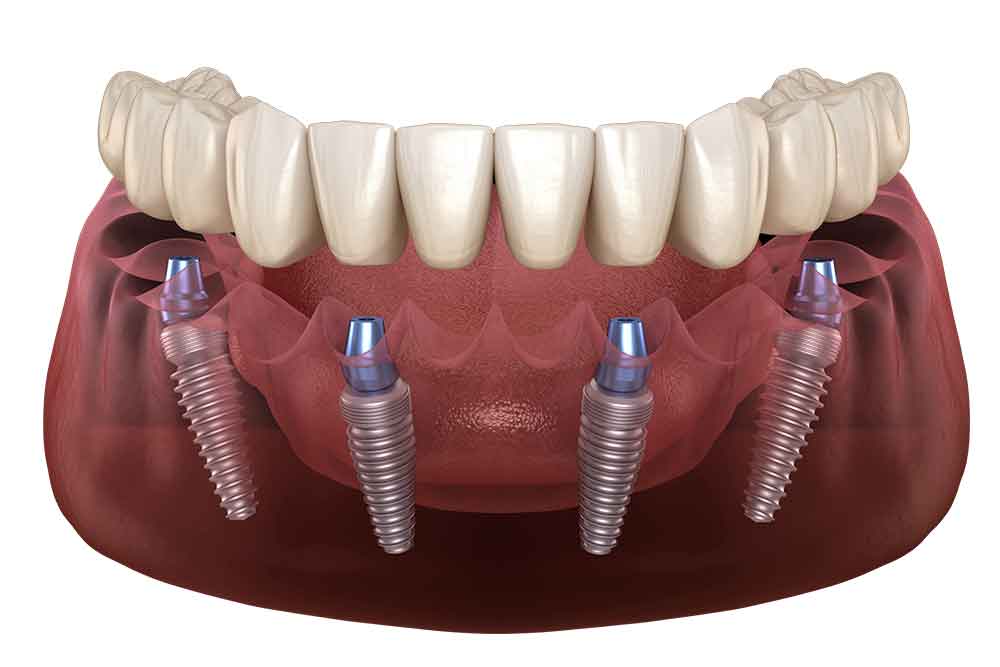 Dental Implant Dentist