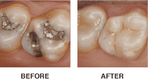 CEREC Dental Crowns Dentist