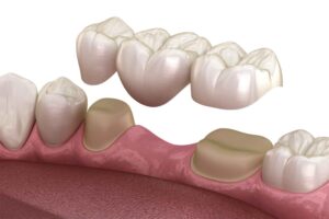 Beyond Repair: How Dental Crowns Revive a Compromised Smile