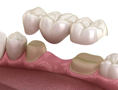 Beyond Repair: How Dental Crowns Revive a Compromised Smile