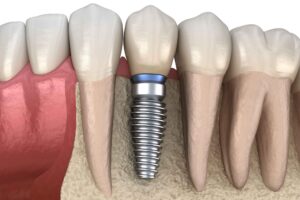 Dentures vs. Dental Implants: Weighing Your Tooth Replacement Options