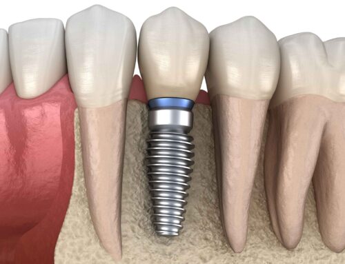 How Many Teeth Can Be Anchored by One Implant?