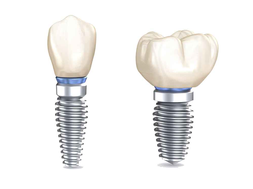 Dental Implants Burlington
