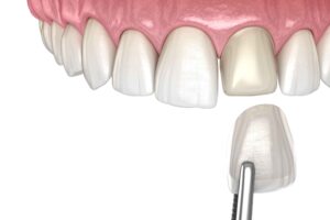 Cracked Tooth Syndrome and the Protective Role of Dental Veneers