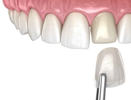 Cracked Tooth Syndrome and the Protective Role of Dental Veneers