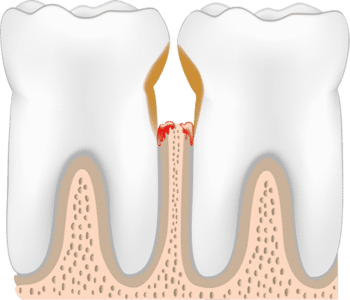 periodontitis-stage-four-periodontitis.png