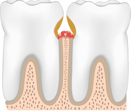 periodontitis-stage-three-periodontal-pockets.png