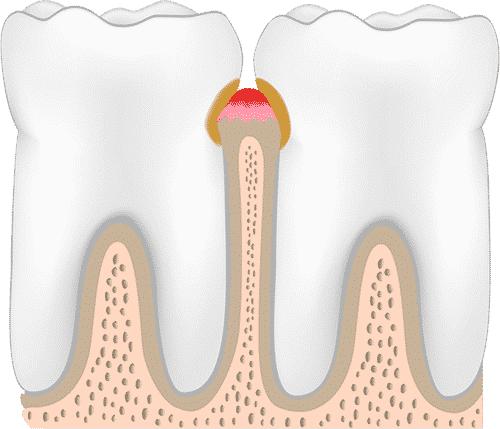 periodontitis-stage-two-gingivitis.png