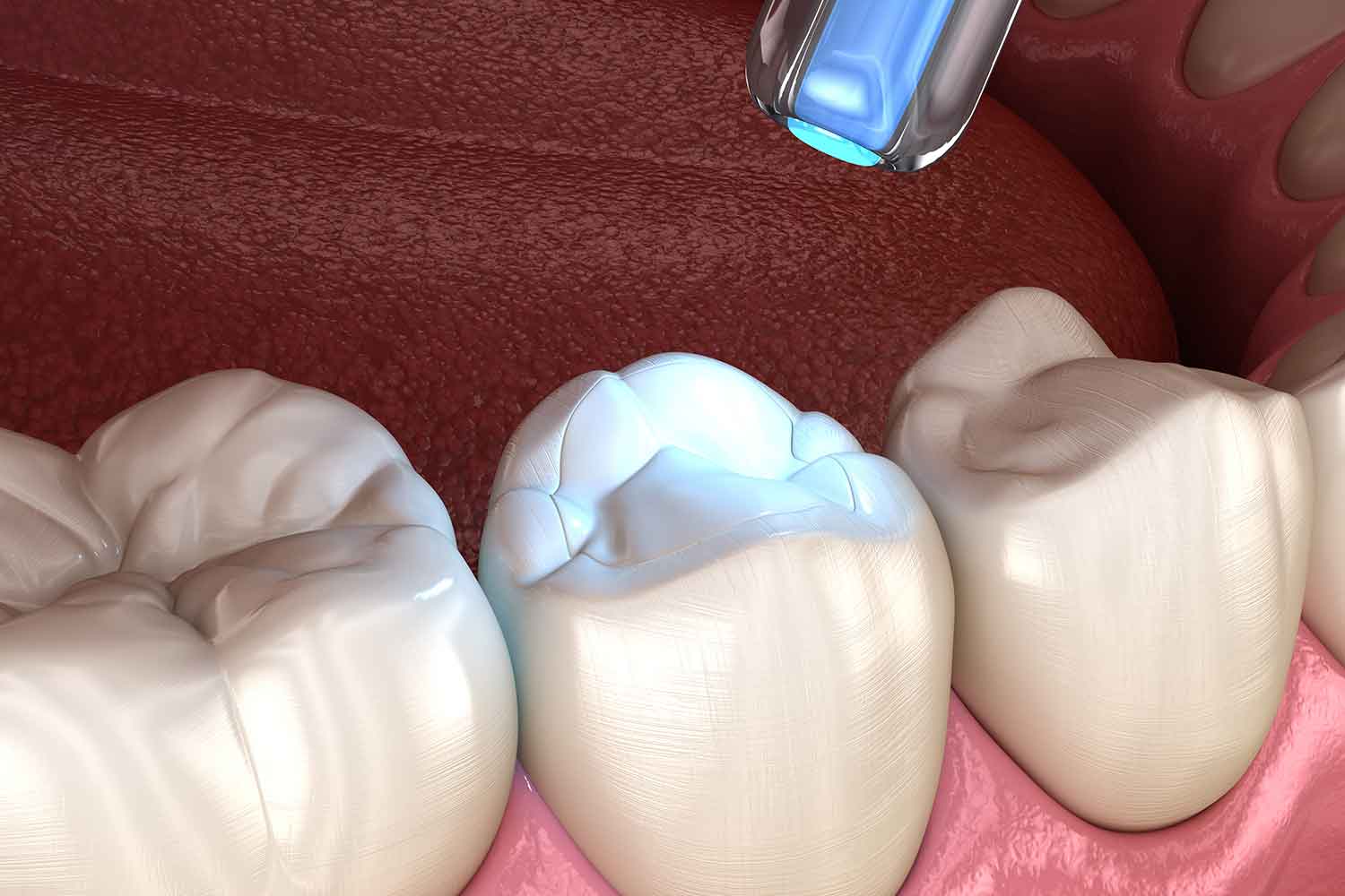 Cavity Tooth Filling Burlington NC