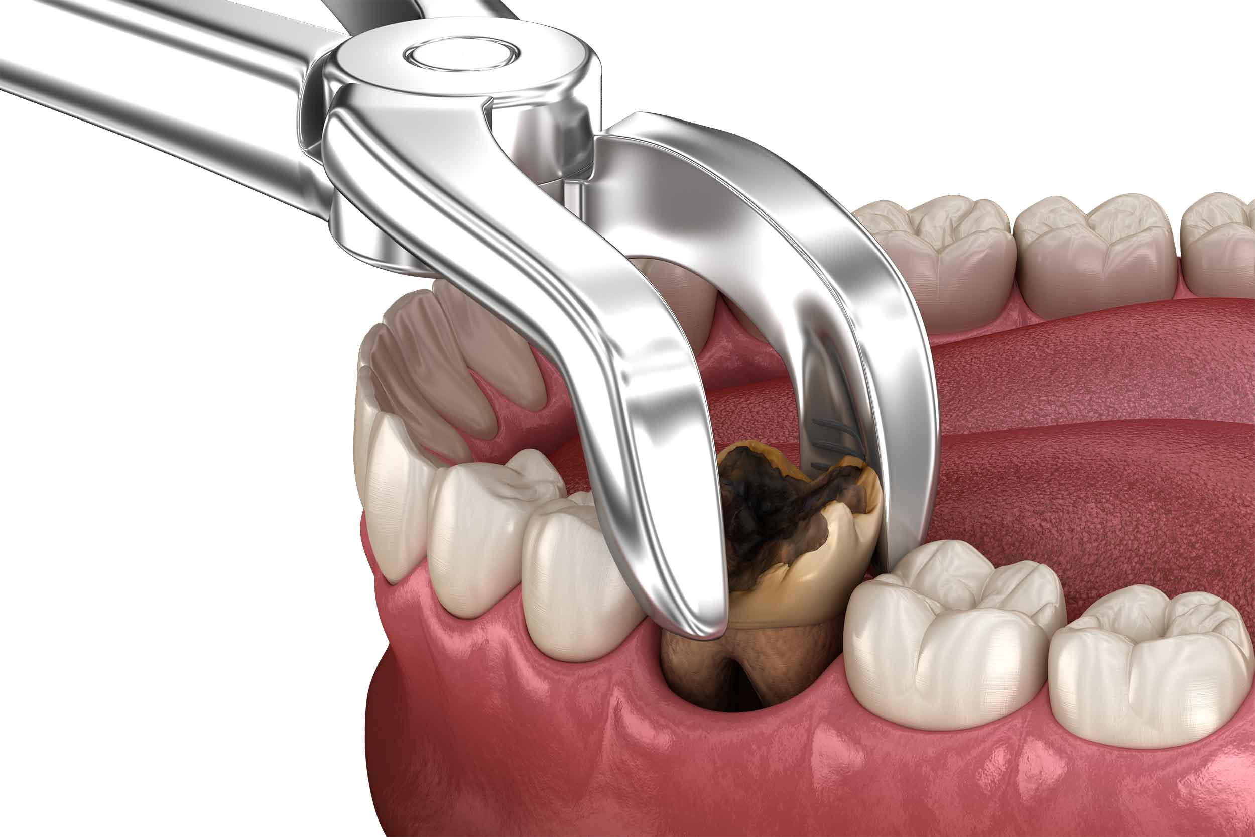 Molar Extraction Brushing Teeth At Ben Birtwistle Blog