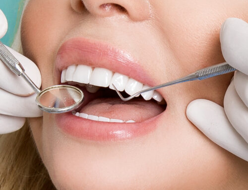 What is Dental Bonding in Cosmetic Dental Work? 