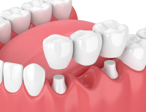 Dental Bridges: Why Dental Bridges Are the Unsung Heroes of Smile Restoration