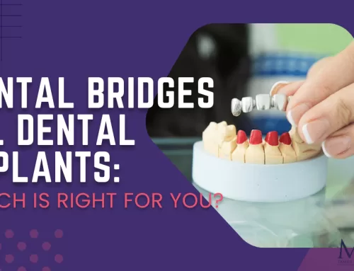 Dental Bridges vs. Dental Implants: Which Is Right for You?