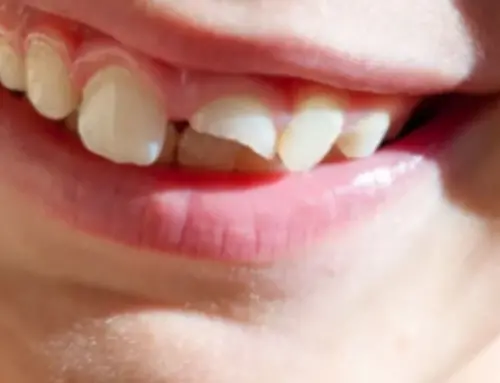 Cosmetic Dentistry: Restoring a Cracked Front Tooth