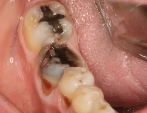 General Dentistry: Assessing a Crumbling Molar’s Health