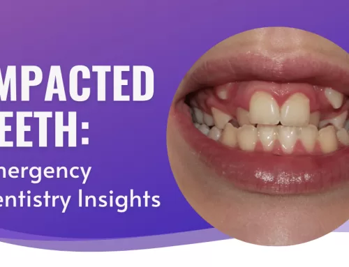 Impacted Teeth: Emergency Dentistry Insights