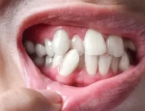 Managing Teeth Crowding: Essential Aspects in Pediatric Dentistry