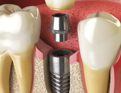 Root Canals and Dental Implants: Can Implants Prevent the Need for Root Canals?