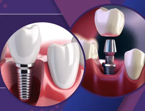 Secure Your Smile with Dental Implants from Burlington, NC Dentist