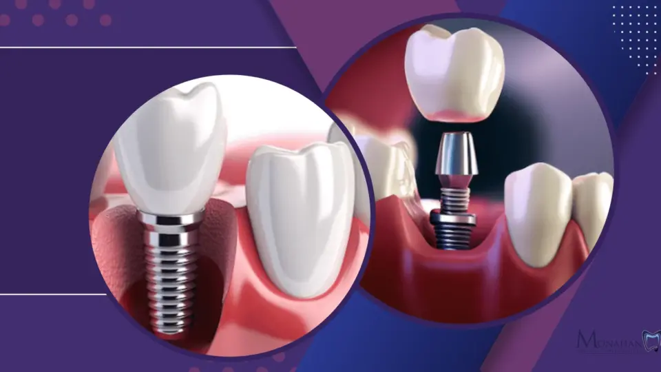 Questions to Ask During a Dental Implant Consultation