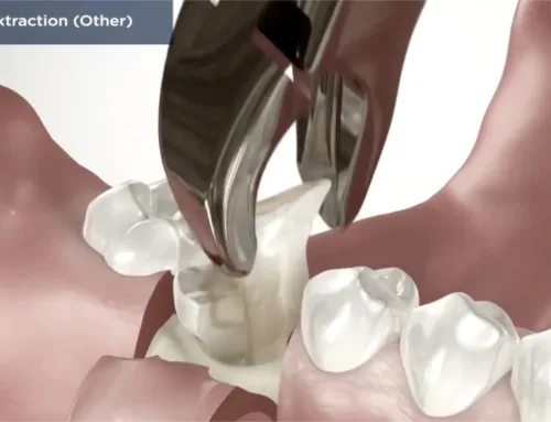 Tooth Extractions: The Art and Strategy of Tooth Extractions in Complex Cases