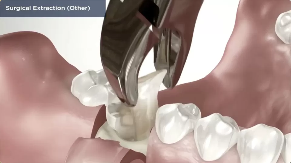 Tooth Extractions: The Art and Strategy of Tooth Extractions in Complex Cases