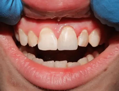Transforming Discolored Teeth: Burlington, NC Teeth Whitening Solutions