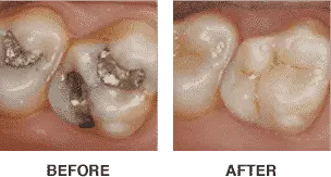Cerec before and after