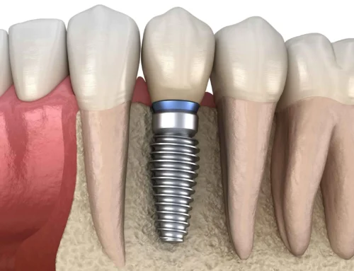 Why Dental Implants are Quietly Replacing an Entire Generation of Tooth Repairs