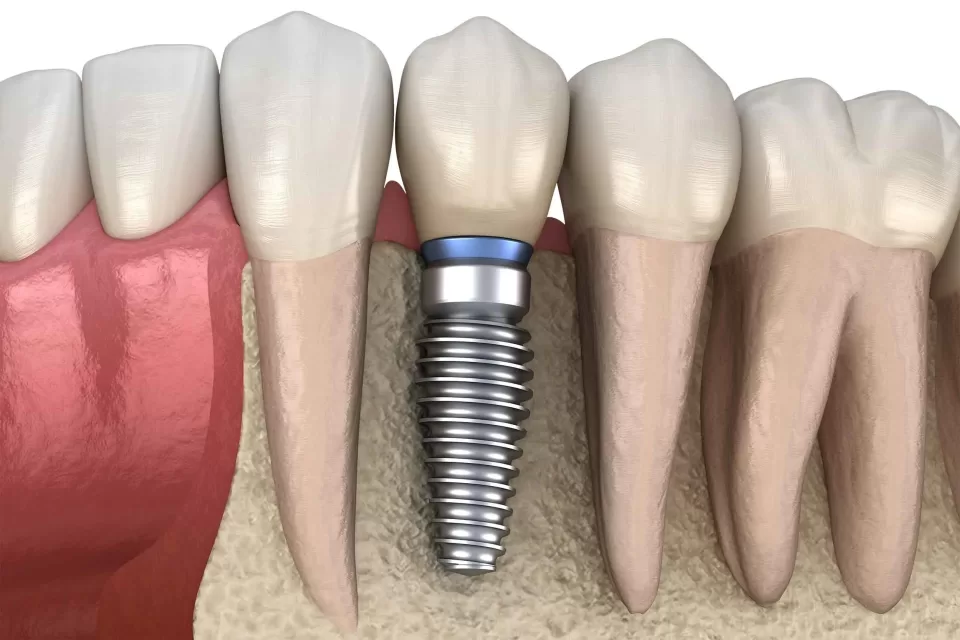 Why Dental Implants are Quietly Replacing an Entire Generation of Tooth Repairs