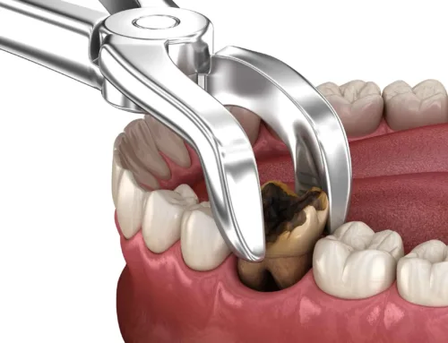 When Tooth Extractions Become Essential: Real-Life Scenarios You Didn’t Know About