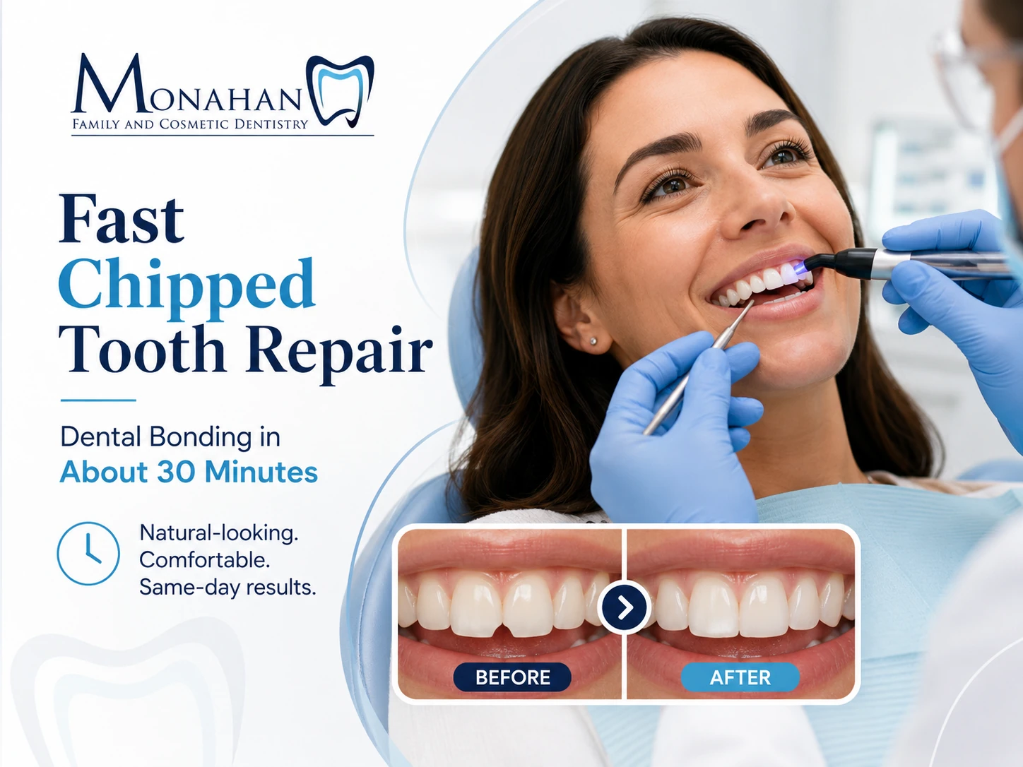Fix a Chipped Tooth in 30 Minutes