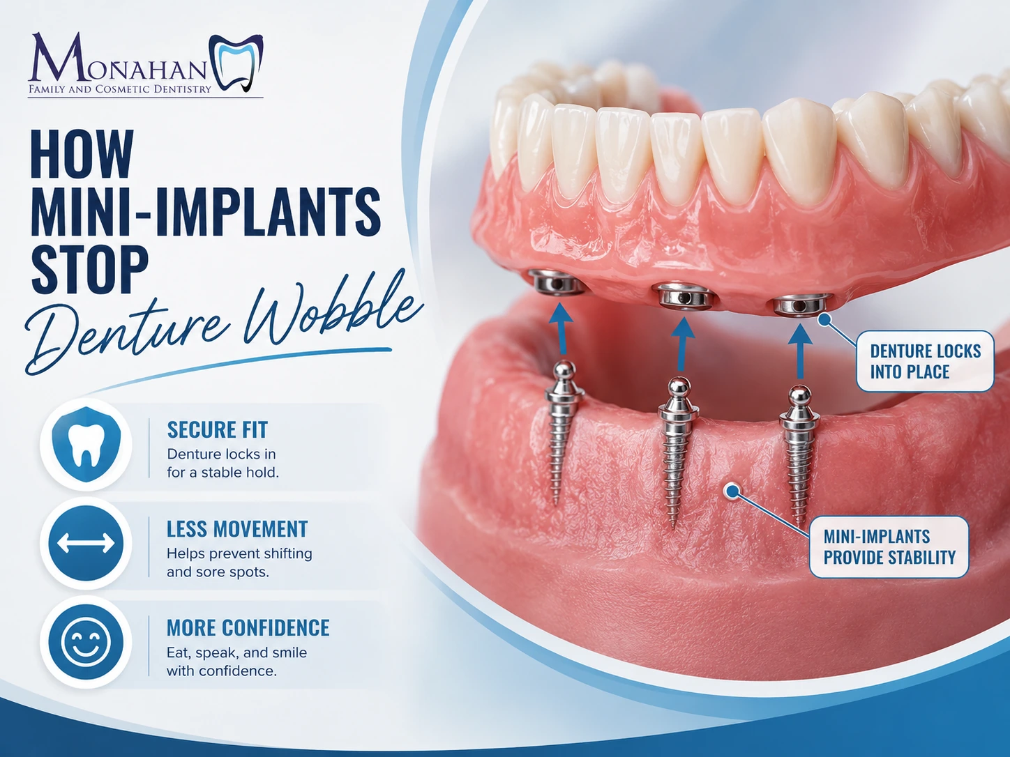 Mini-Implants to Lock Down Your Teeth