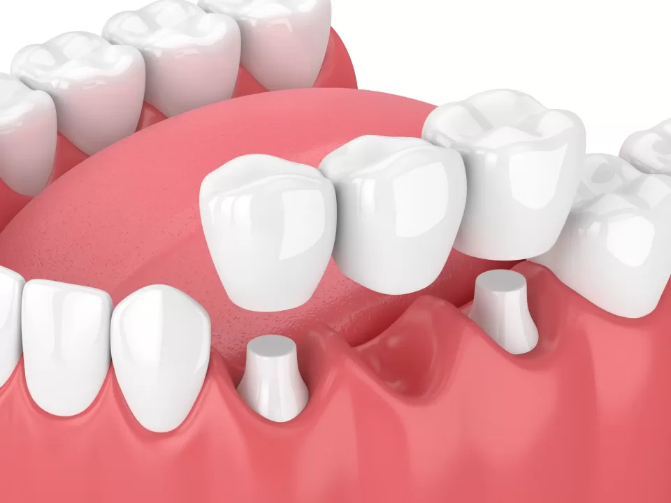 The Surprising Ways Dental Bridges Influence Your Bite’s “Personality”