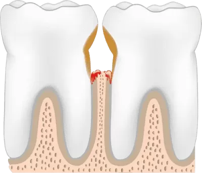 periodontitis-stage-four-periodontitis-400x343.webp