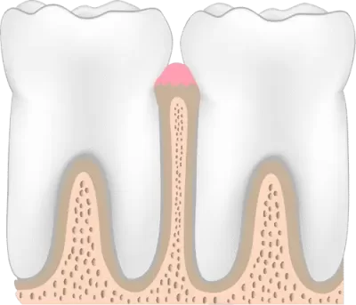 periodontitis-stage-one-healthy-tooth-400x343.webp
