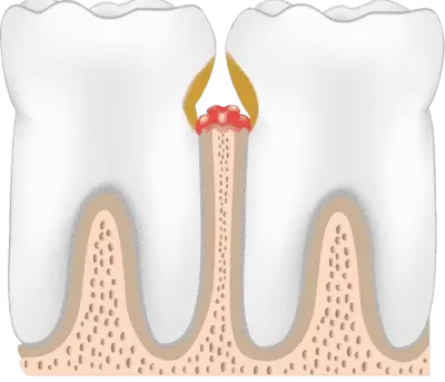 periodontitis-stage-three-periodontal-pockets-400x343.webp