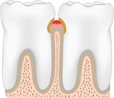periodontitis-stage-two-gingivitis-400x343.webp