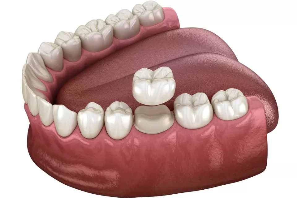 How to Choose the Right Dentist for Dental Crowns and Restorative Work